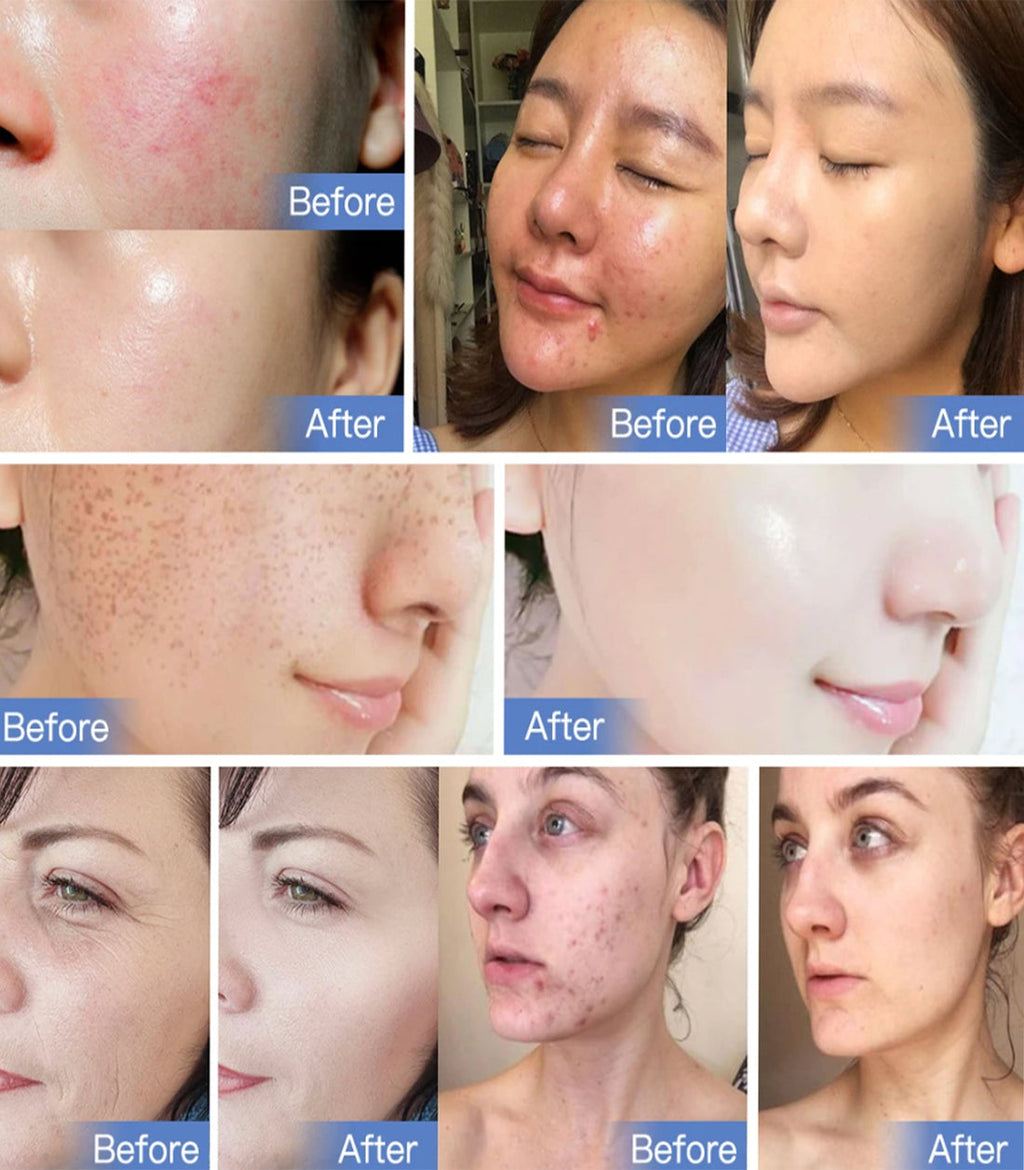 AstraGlow 7-Color LED Light Therapy For Radiant Skin