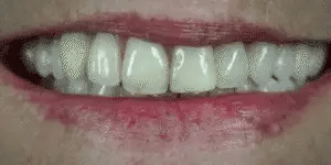 LumaGrin Instant Snap-On Veneers For Upper and Lower Teeth