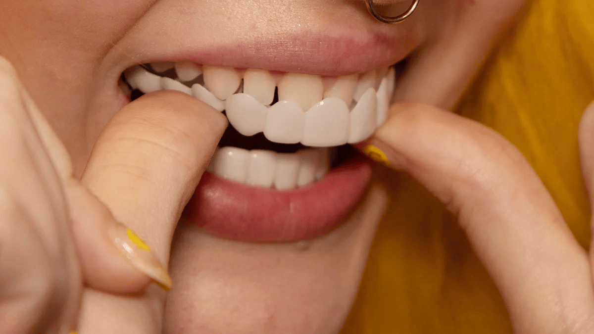 Fațete Instantanee LumaGrin cu Fixare Rapidă pentru Dinții Superiori și Inferiori