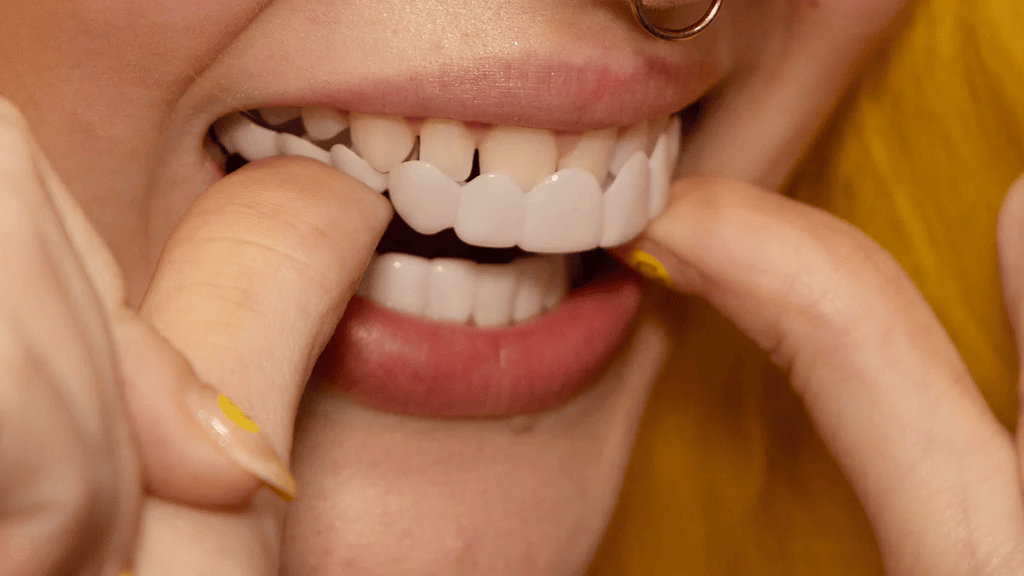 قشور نوفابرايت القابلة للتركيب للأسنان العلوية والسفلية ابتسامة طبيعية فورية