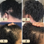 Aceite nutritivo para el cuero cabelludo AureaGrow para ayudar al cabello fino