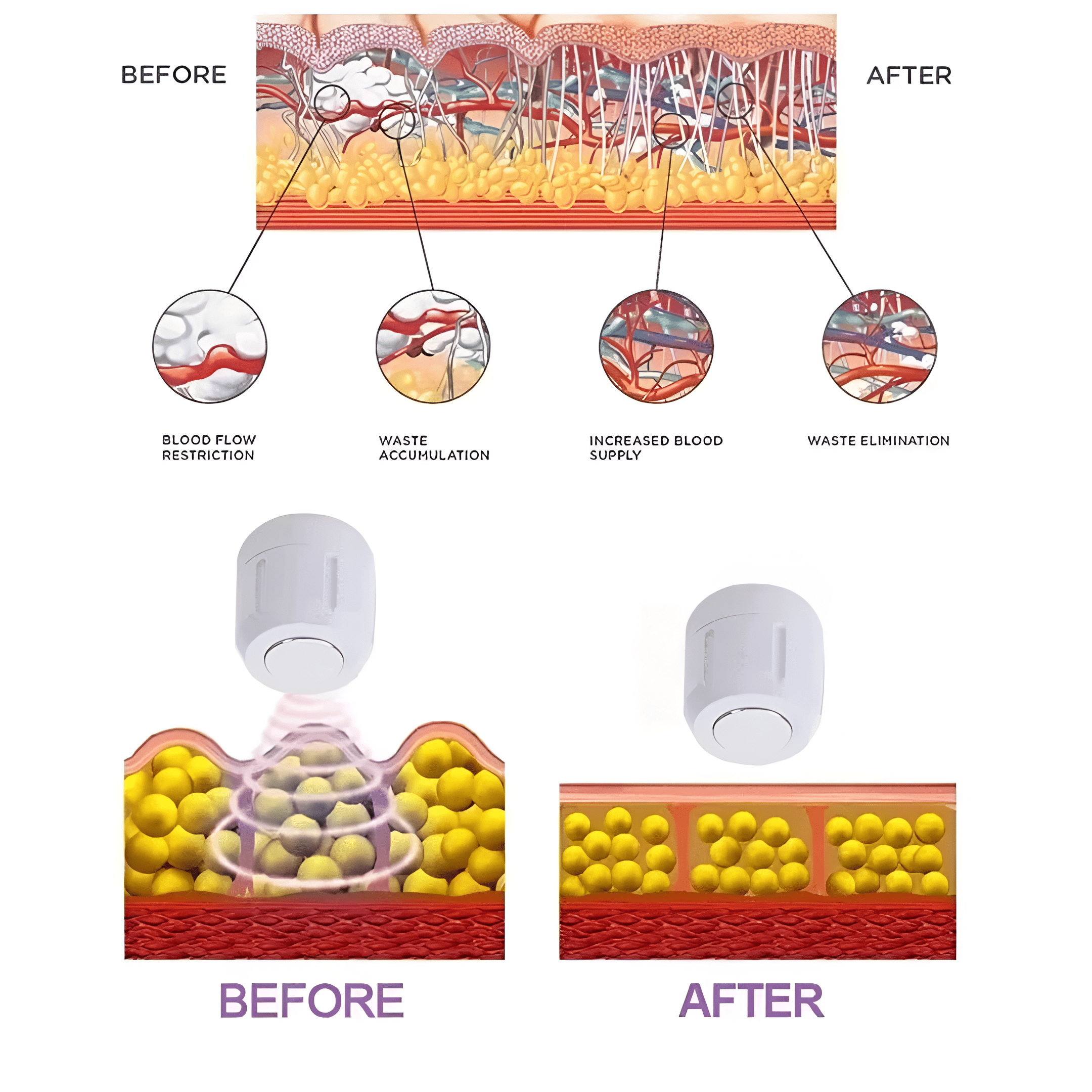 VeloPulse Kompakt Radial Stødterapiapparat til Plantar Fasciitis