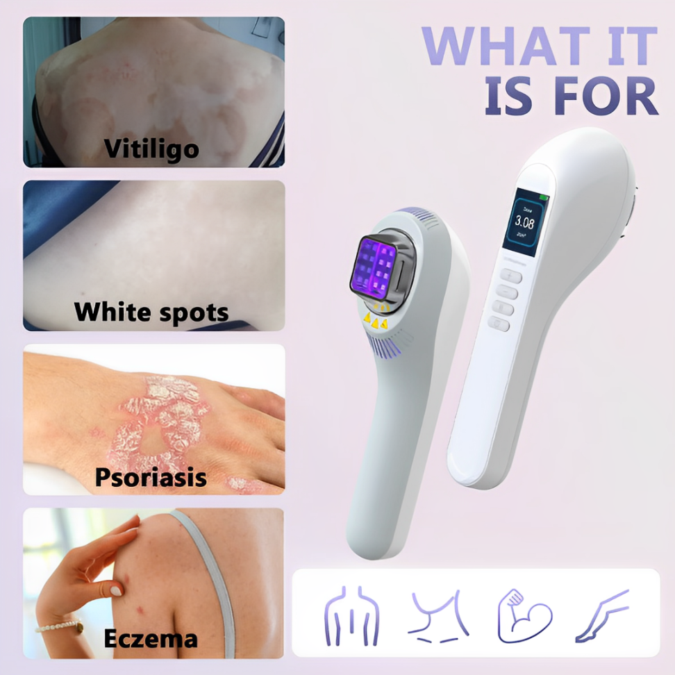 Vitiligo- und Psoriasis-Behandlung zu Hause mit 308-nm-UVB-Lampe