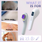 Vitiligo- und Psoriasis-Behandlung zu Hause mit 308-nm-UVB-Lampe