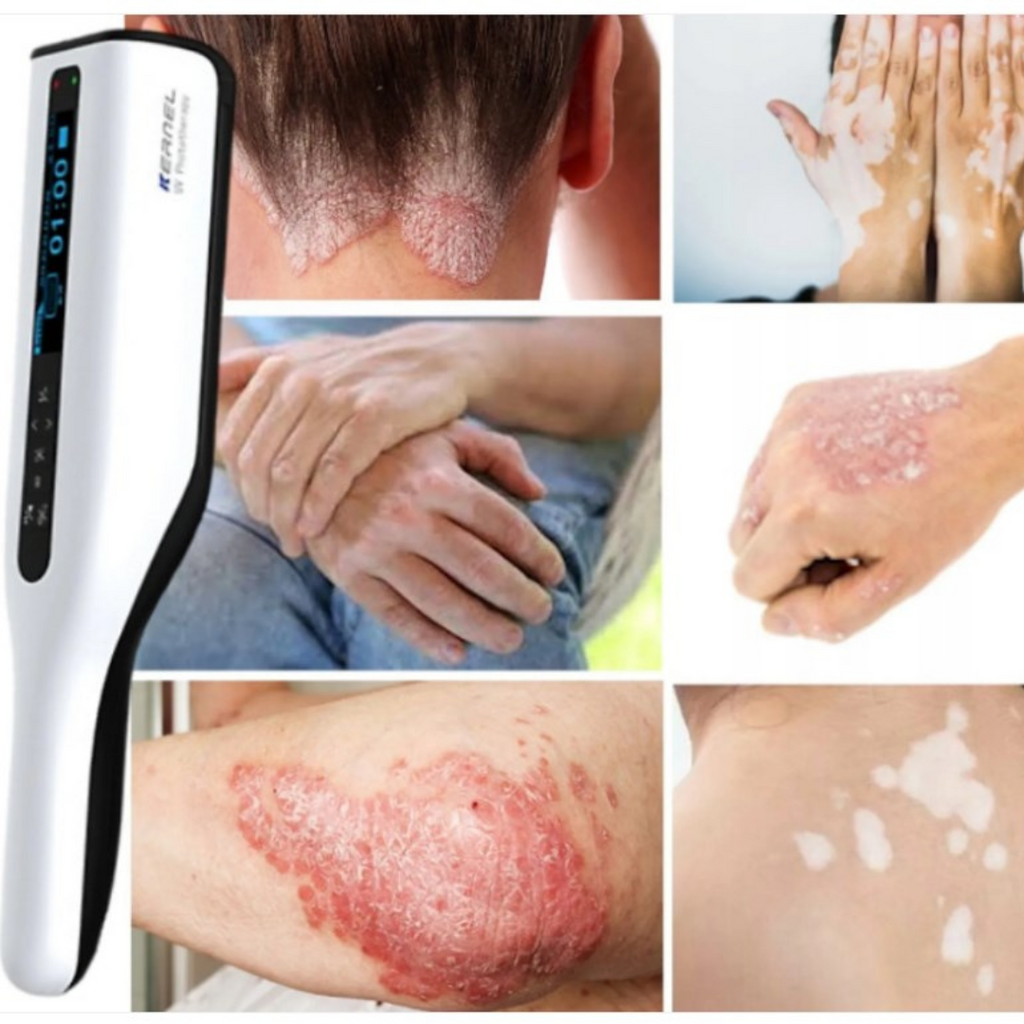 DermaLuma bærbar UVB-terapilampe til psoriasis og vitiligo derhjemme