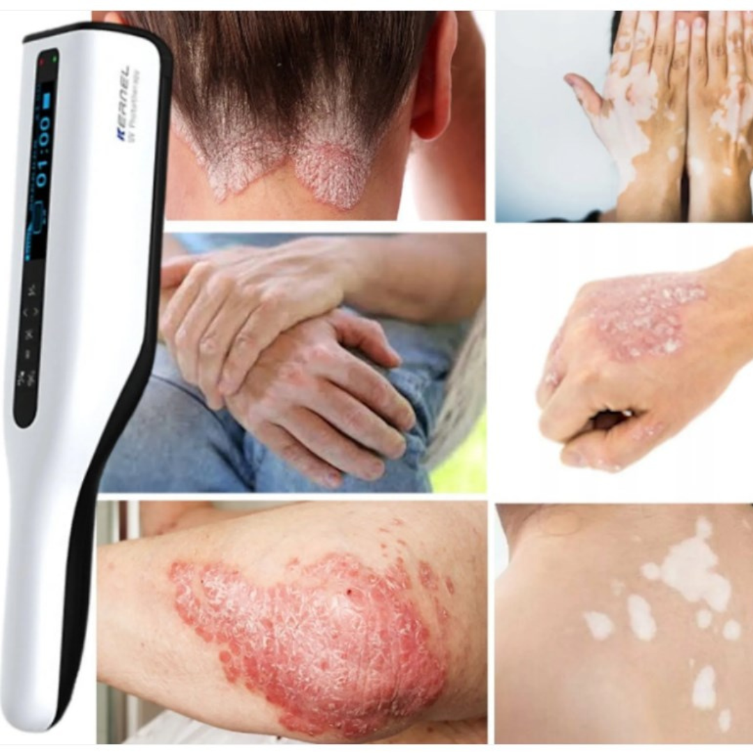 DermaLuma bærbar UVB-terapilampe til psoriasis og vitiligo derhjemme