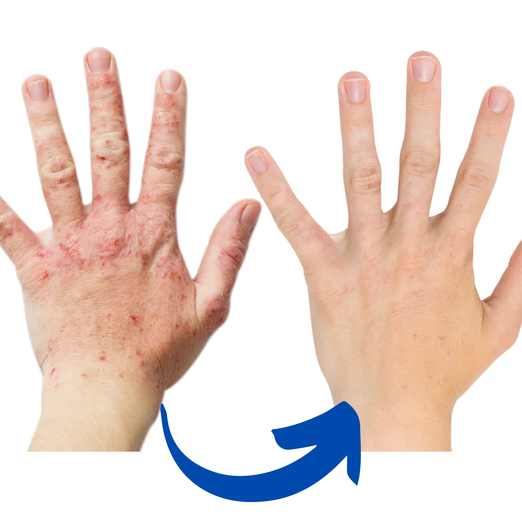 ArthroGlow Near Infrared Hand Therapy Gloves for Arthritis