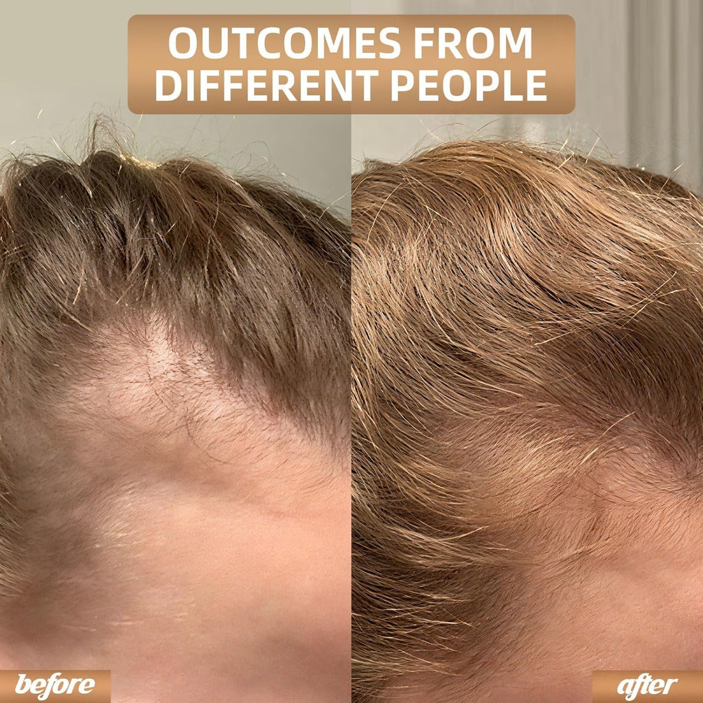 REGENVIE Pro At Home Hair Renewal Solution For Lasting Density
