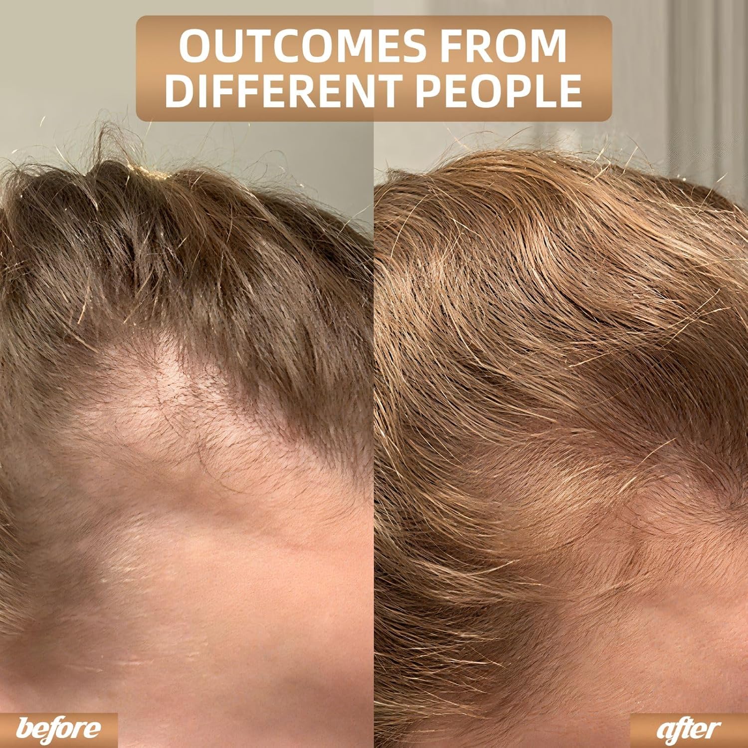 REGENVIE Pro At Home Hair Renewal Solution For Lasting Density