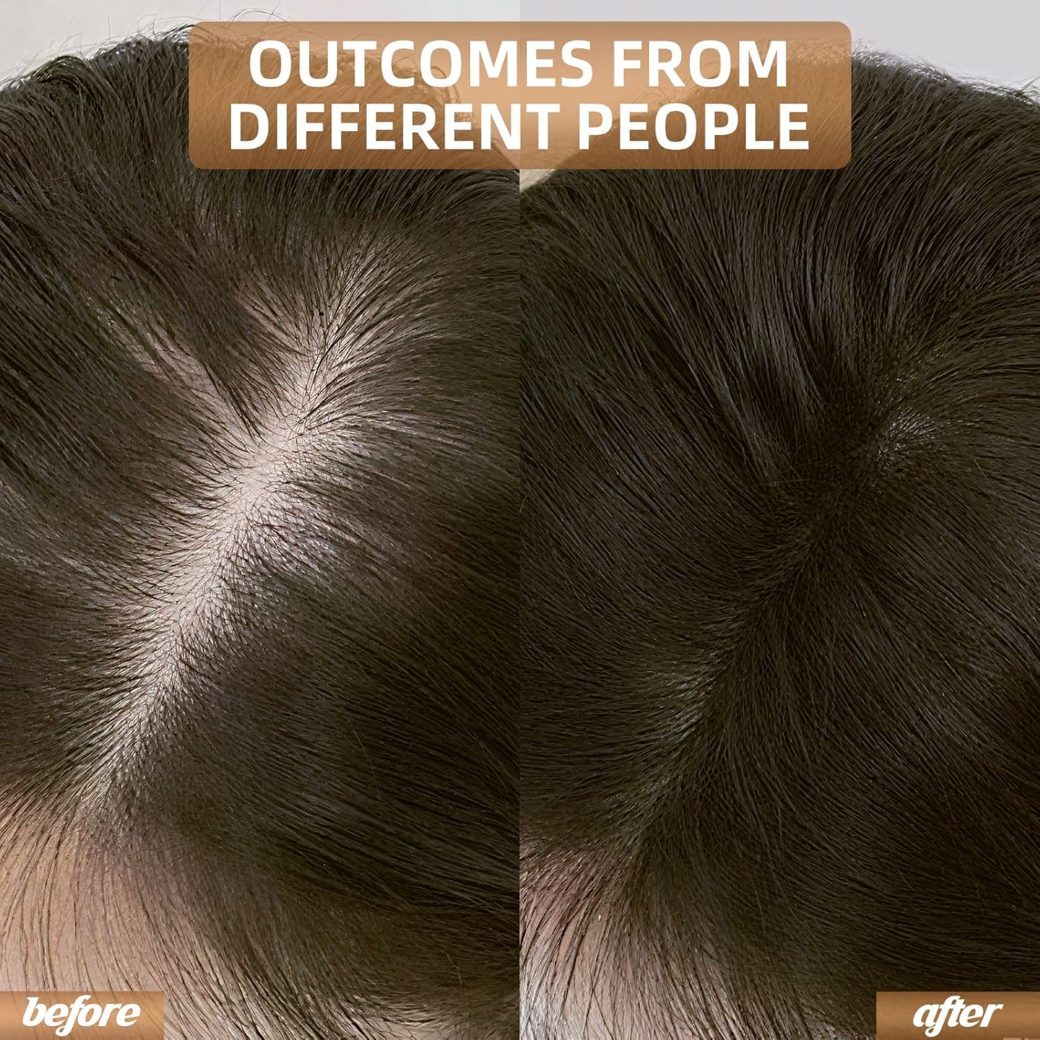 REGENVIE Pro At Home Hair Renewal Solution For Lasting Density