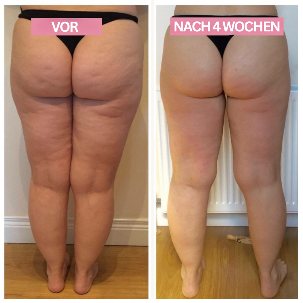 Slimcupp Dispositivo per Coppettazione a Casa per Rassodamento della Pelle e Cellulite