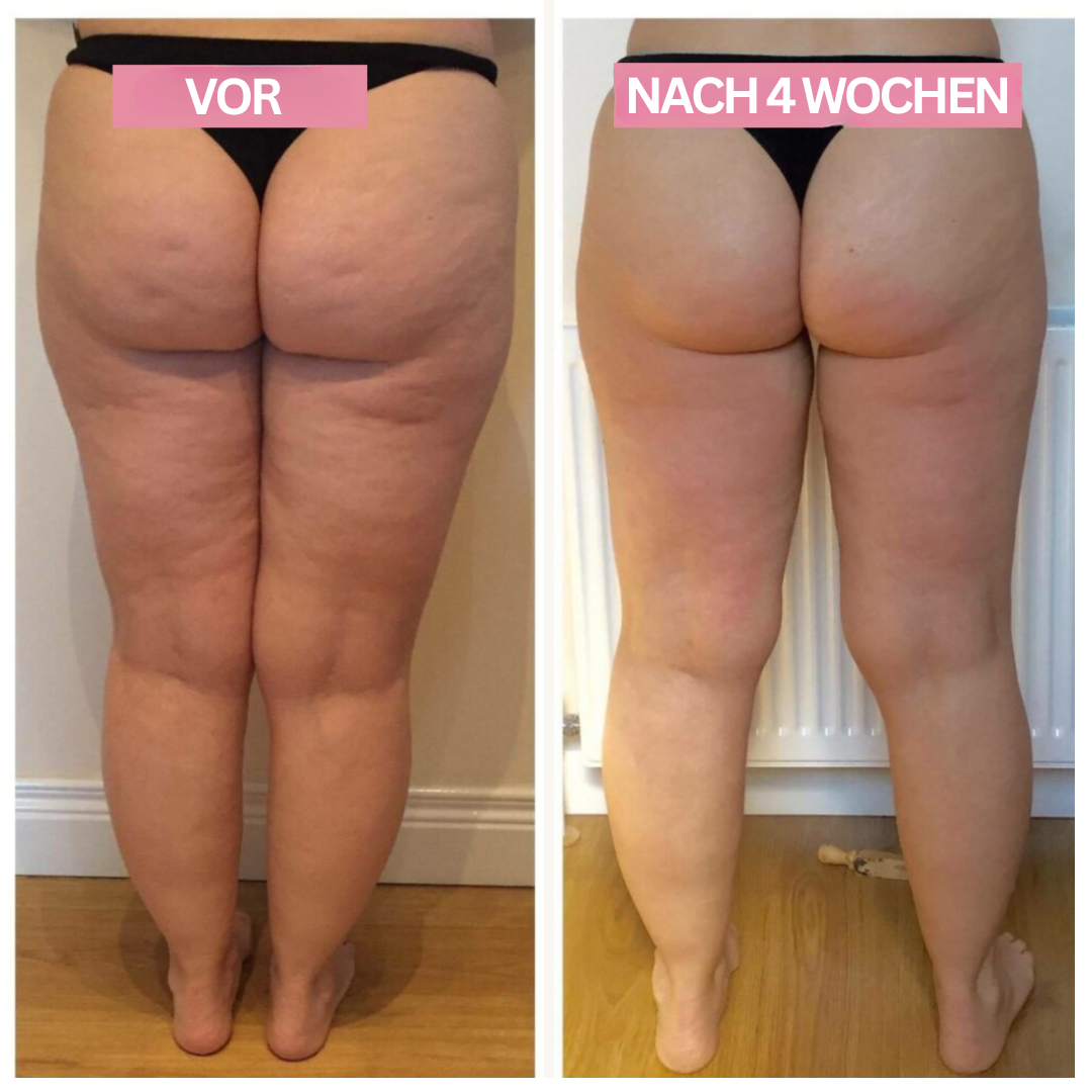 Slimcupp Dispositivo per Coppettazione a Casa per Rassodamento della Pelle e Cellulite