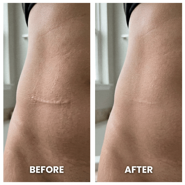 SilkScar silikonová páska | Lékařská léčba jizev pro ploché, měkké jizvy