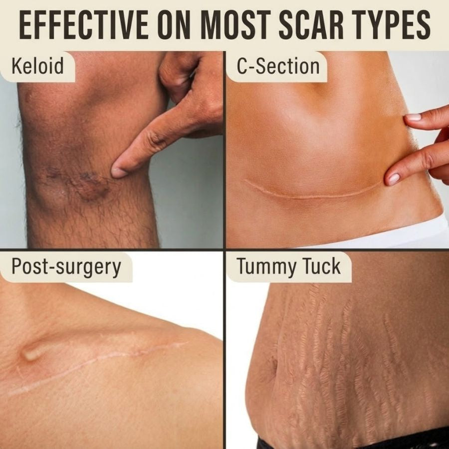 SilkScar silikonová páska | Lékařská léčba jizev pro ploché, měkké jizvy
