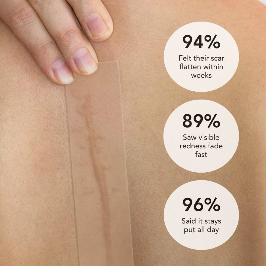 SilkScar silikonová páska | Lékařská léčba jizev pro ploché, měkké jizvy