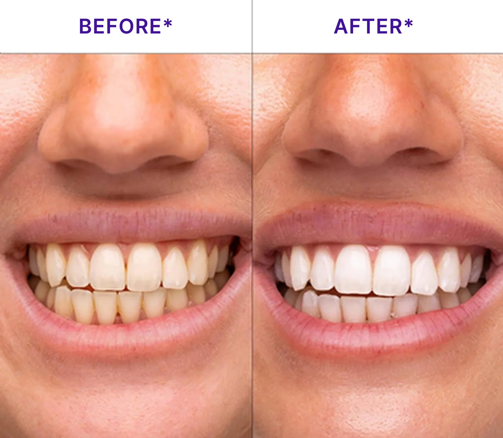 V34 Teeth Whitening Strips