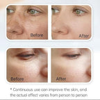 Hydra Pen H3 Mikronakłuwanie z Infuzją Serum dla Miłośników Pielęgnacji Domowej