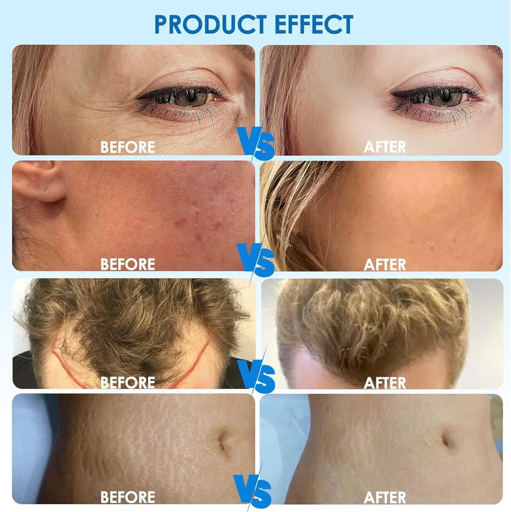 Hydra Pen H3 Mikronakłuwanie z Infuzją Serum dla Miłośników Pielęgnacji Domowej