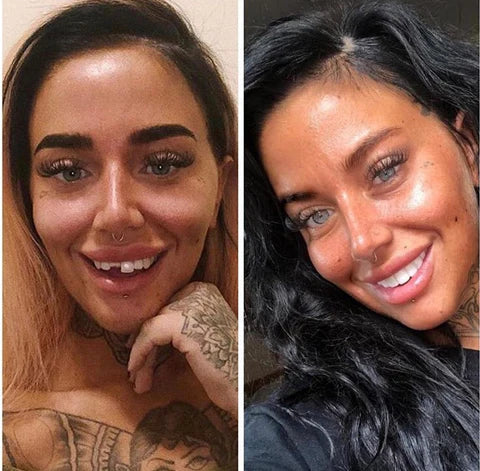 Fațete Instantanee LumaGrin cu Fixare Rapidă pentru Dinții Superiori și Inferiori