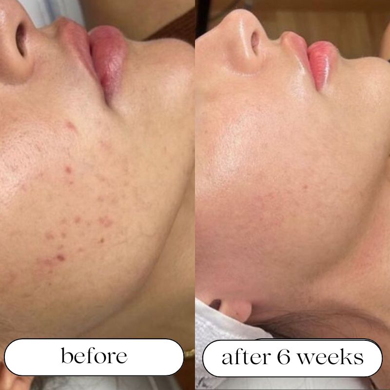 Seven-Wavelength LED Skin Care Device With Light Therapy