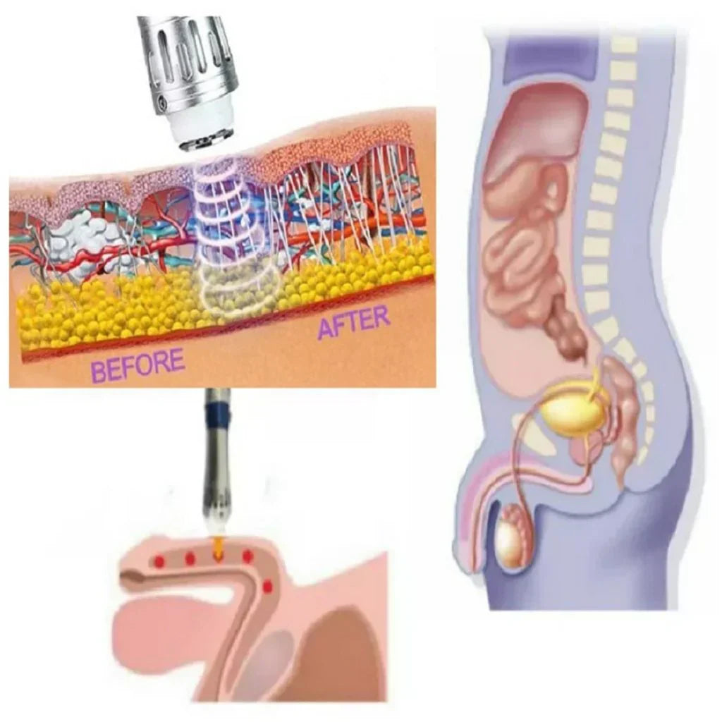 NovaPulse hordozható lökéshullám-terápiás készülék férfiaknak tokban és tartozékokkal