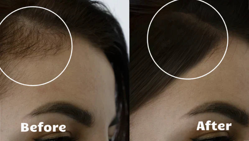 Zařízení Light Wave s červeným světlem pro růst vlasů pomáhá při řídnutí vlasů