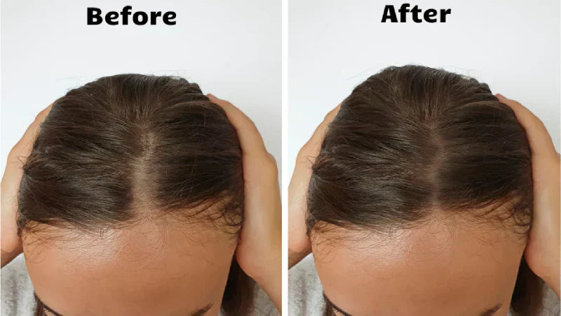 Zařízení Light Wave s červeným světlem pro růst vlasů pomáhá při řídnutí vlasů