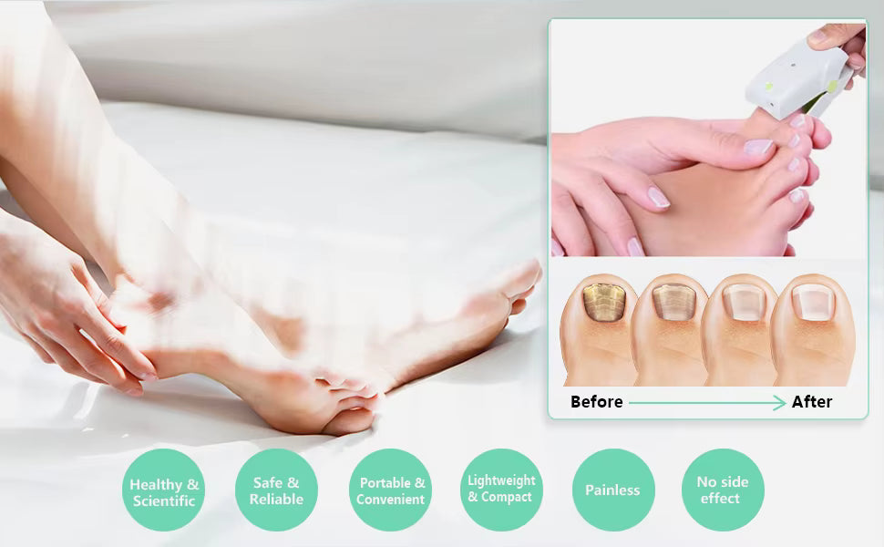 NovaNail laser for sopp i finger- og tånegler hjemme