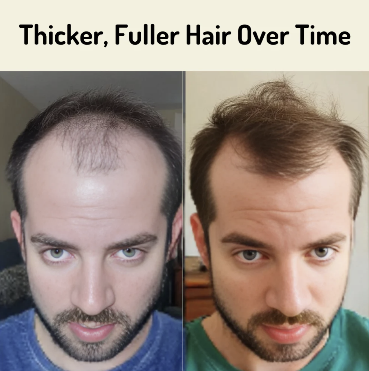 NovaLuma Hårvækst Rødt Lys Terapi Kasket til Hjemmebrug