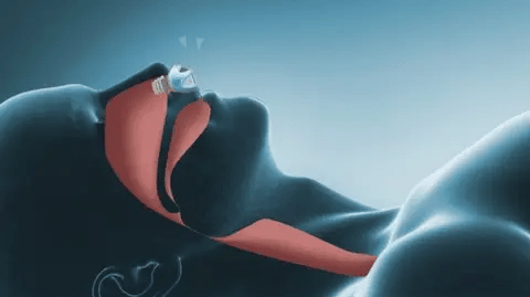 AstraSleep Mini CPAP Reise-Schlafhilfe Gerät ohne Schlauch