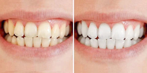 تبييض الأسنان السريع لابتسامة أكثر إشراقًا