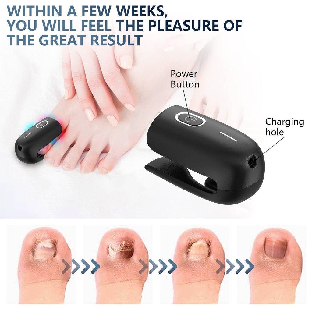 ApexNova Toenail Fungus Laser Therapy Device for Home Use
