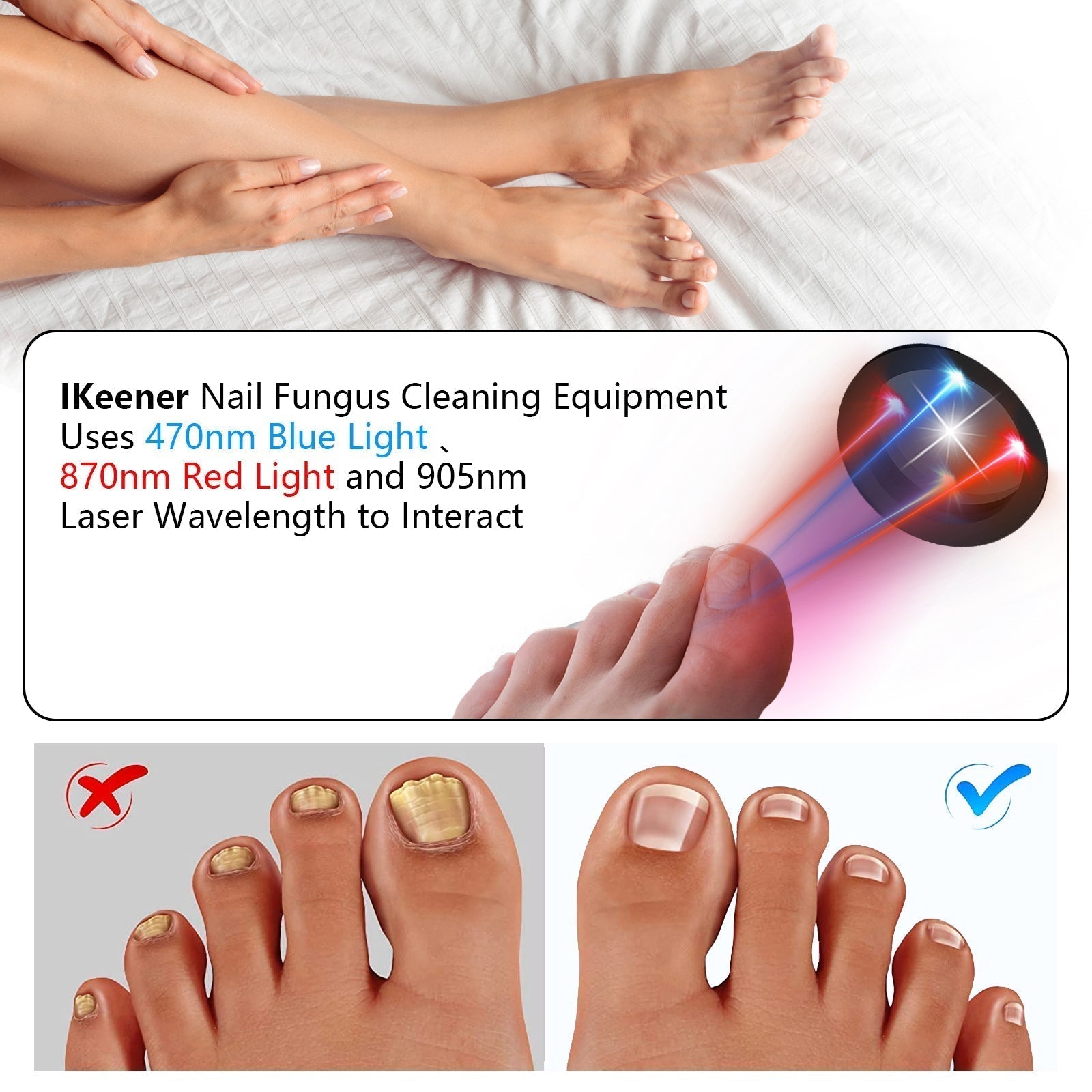 ApexNova Toenail Fungus Laser Therapy Device for Home Use