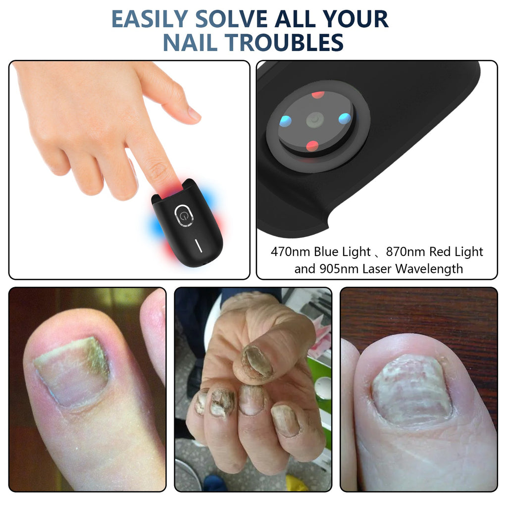 ApexNova Toenail Fungus Laser Therapy Device for Home Use