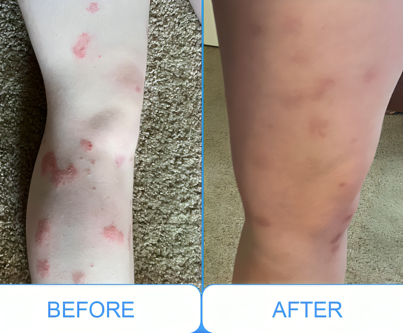 DermaLuma bærbar UVB-terapilampe til psoriasis og vitiligo derhjemme