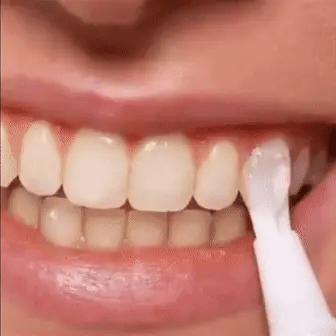 تبييض الأسنان السريع لابتسامة أكثر إشراقًا
