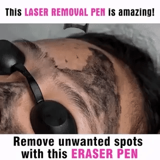 LumiDerm Laser Pen for Tattoo, Moles & Freckles Removal