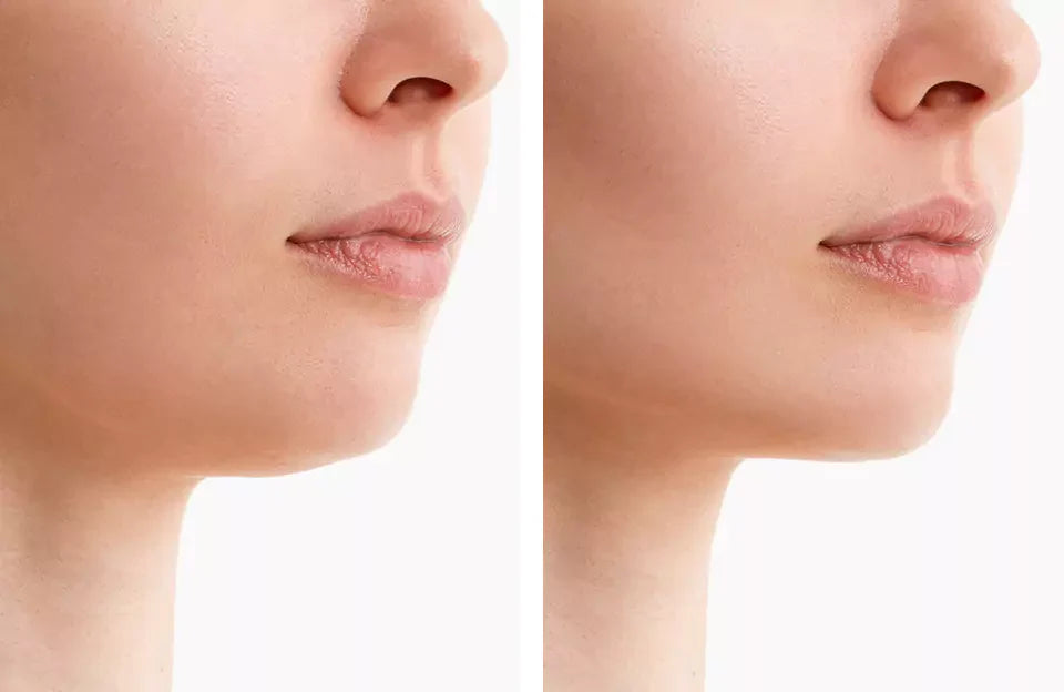 NovaLume ChinContour Rotlicht-Therapie-Gürtel für Doppelkinn