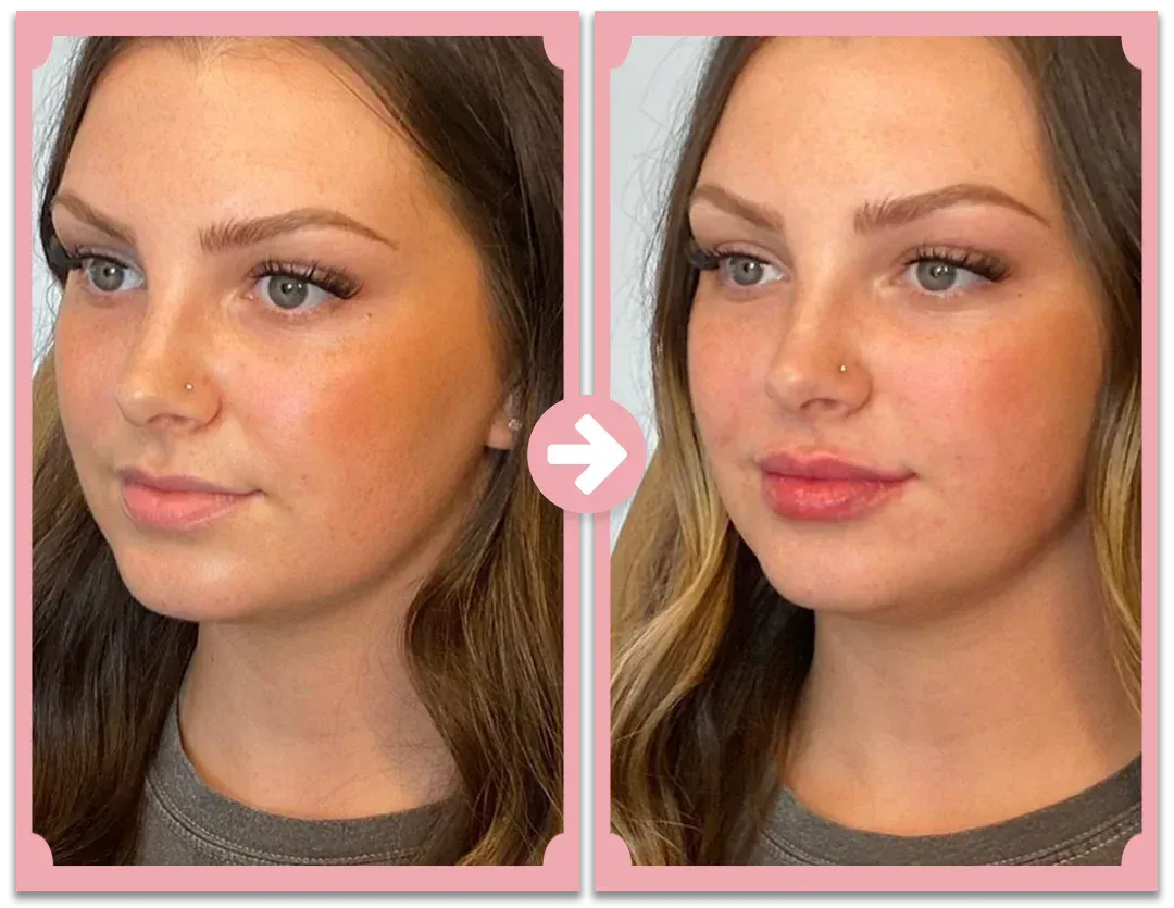 نظام نوفا ليبس لتكبير الشفاه مع أسطوانة إبر دقيقة 0.5 مم