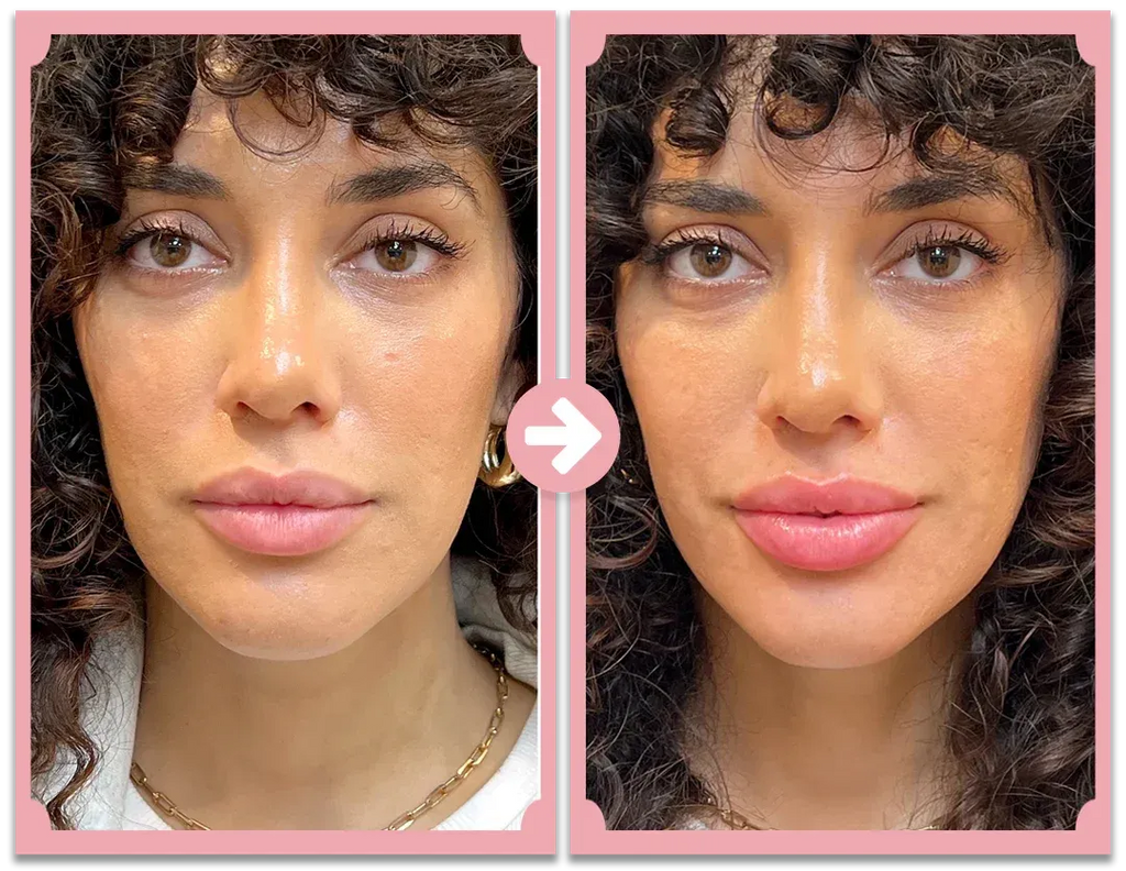 نظام نوفا ليبس لتكبير الشفاه مع أسطوانة إبر دقيقة 0.5 مم