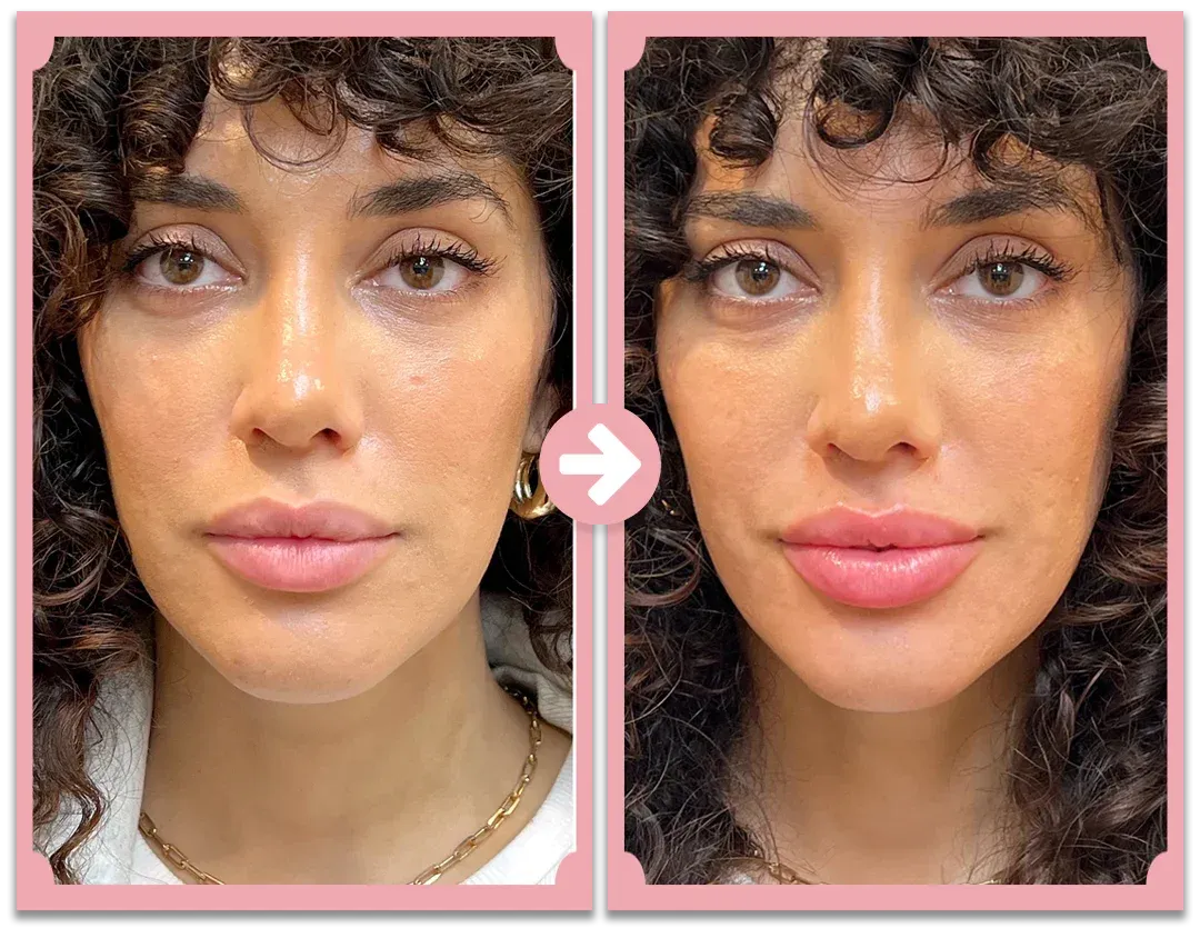 نظام نوفا ليبس لتكبير الشفاه مع أسطوانة إبر دقيقة 0.5 مم