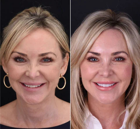 قشور نوفابرايت القابلة للتركيب للأسنان العلوية والسفلية ابتسامة طبيعية فورية