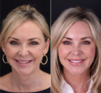 Fațete Instantanee LumaGrin cu Fixare Rapidă pentru Dinții Superiori și Inferiori