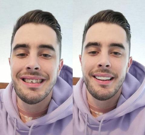 LumaGrin Instant Snap-On Veneers For Upper and Lower Teeth