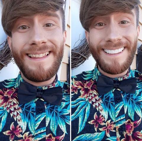 Fațete Instantanee LumaGrin cu Fixare Rapidă pentru Dinții Superiori și Inferiori