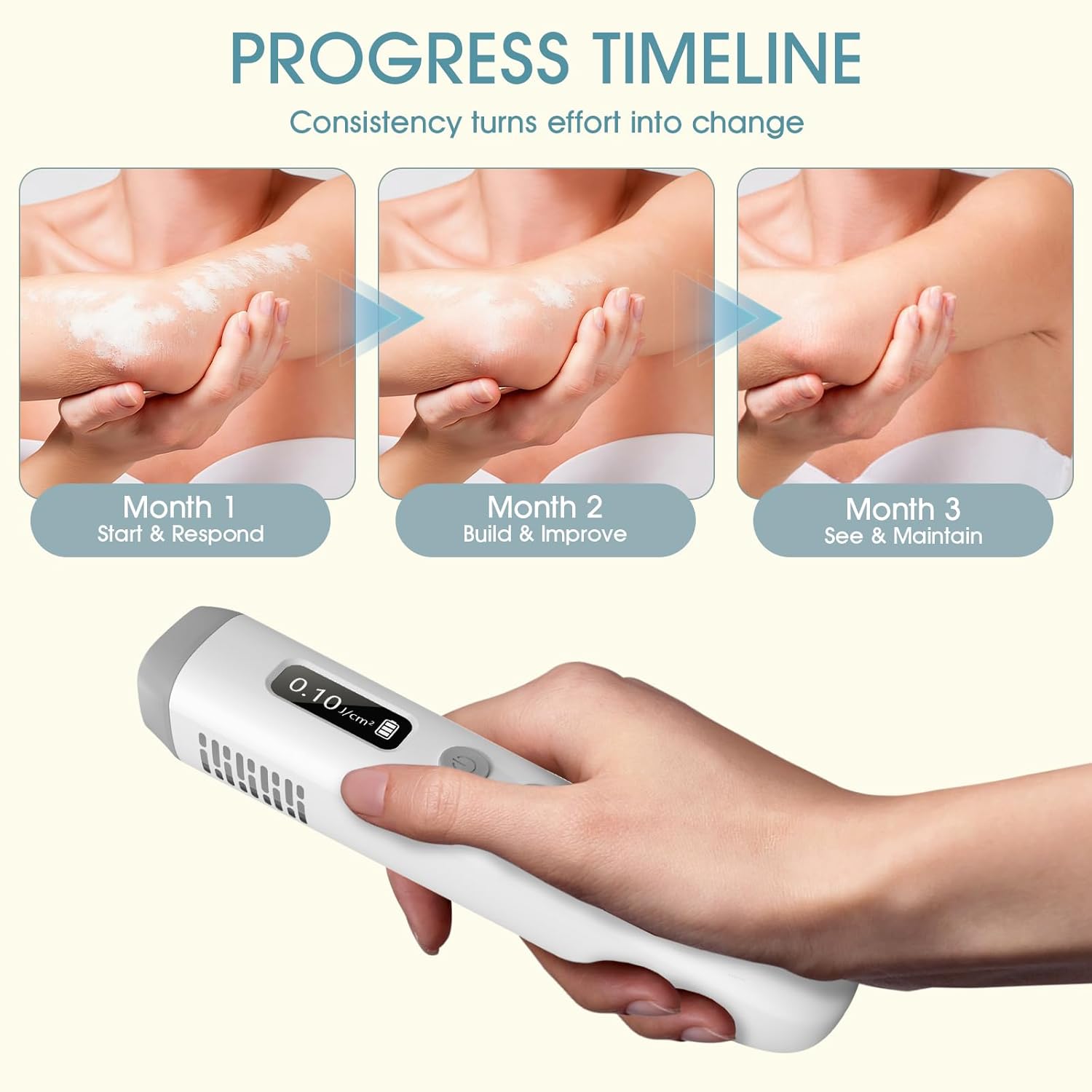 Dispositivo Portatile di Fototerapia UVB 308nm 2026 – Trattamento Domestico per Psoriasi, Eczema, Vitiligine e Altro