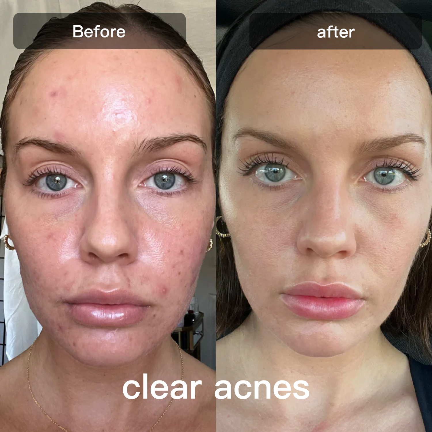 جهاز علاج بالضوء LED | جهاز علاج بالضوء LED بسبعة أطوال موجية للوجه والجسم