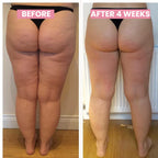 CelluLift Hudopstrammende Vakuummassage til Kvinder med Cellulite