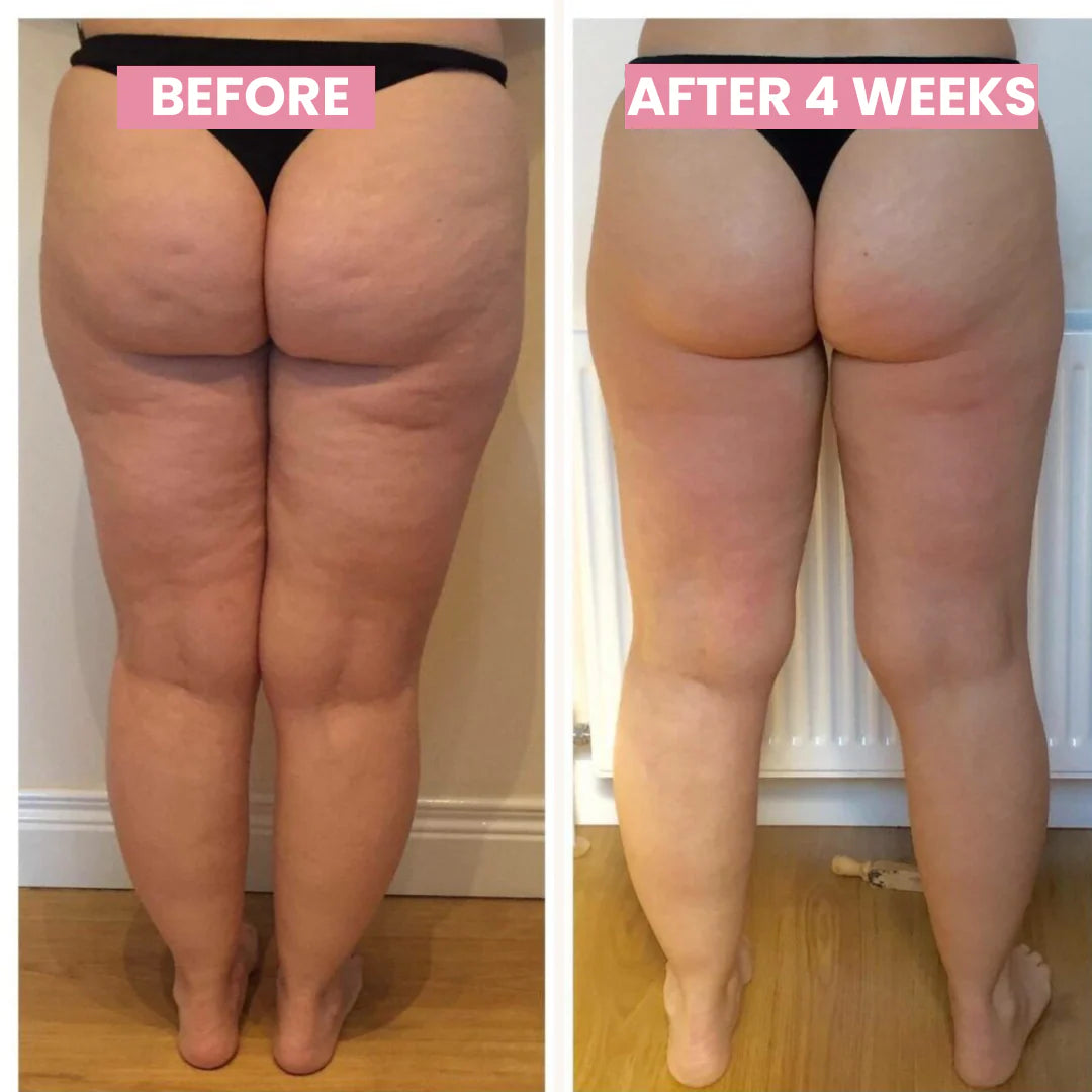 CelluLift Hudopstrammende Vakuummassage til Kvinder med Cellulite