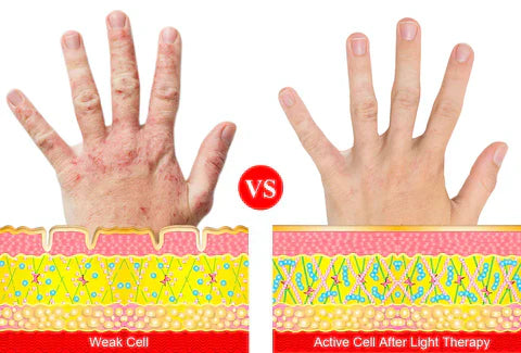 Arthritis Hand Glove With Red Light For Pain Relief At Home
